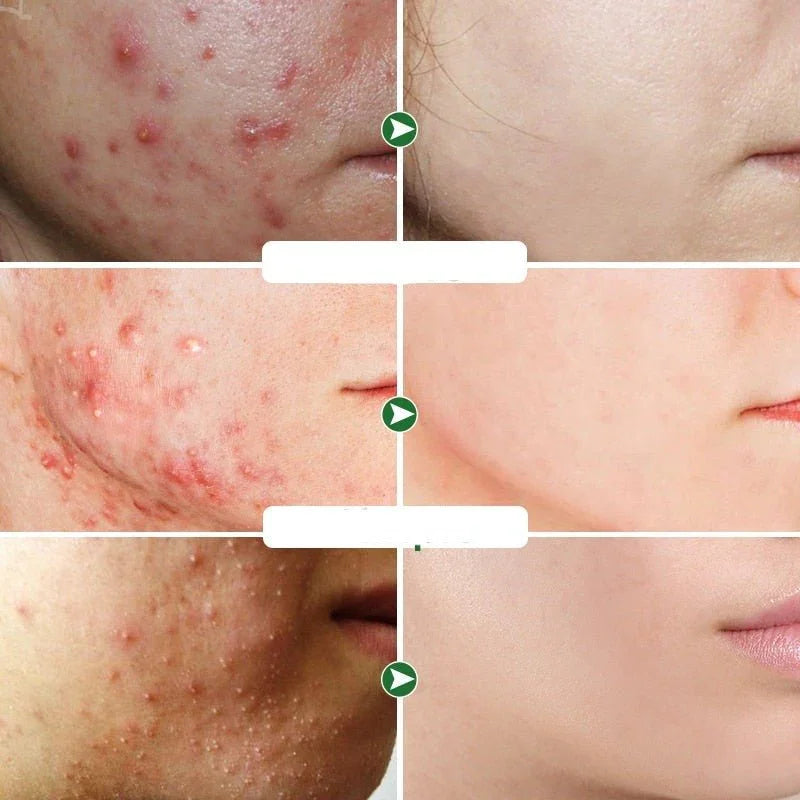 Acne creme facial. - Zaya Femme