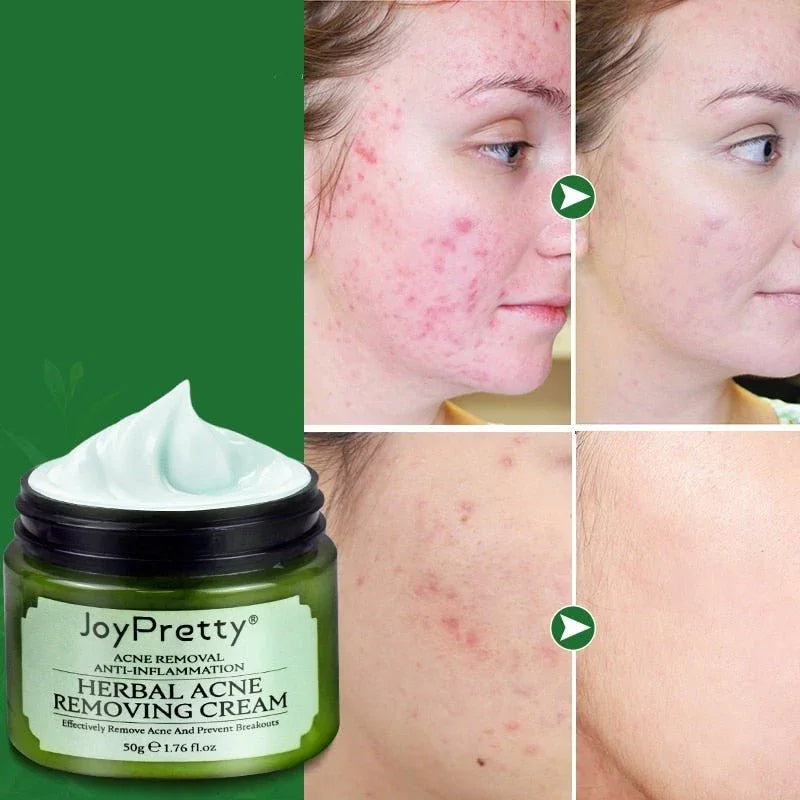 Acne creme facial. - Zaya Femme